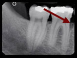 Parodontologie Roentgen 1